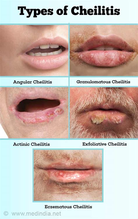 Angular cheilitis: Causes, symptoms, treatment and。